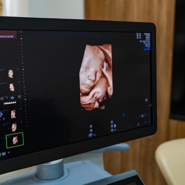 Échographie 3D / 4D — rendu en relief du visage du bébé à l'écran